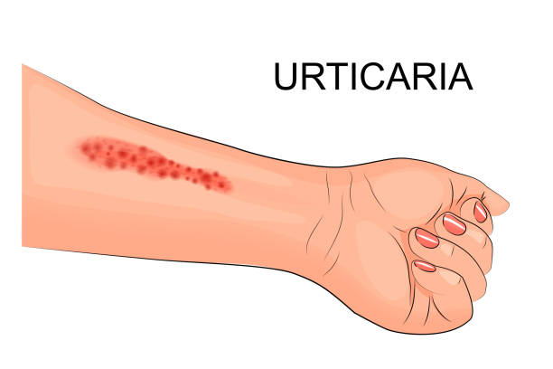 illustration of a hand of the patient suffering from hives"n