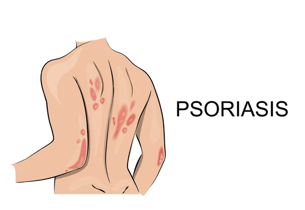 psoriase